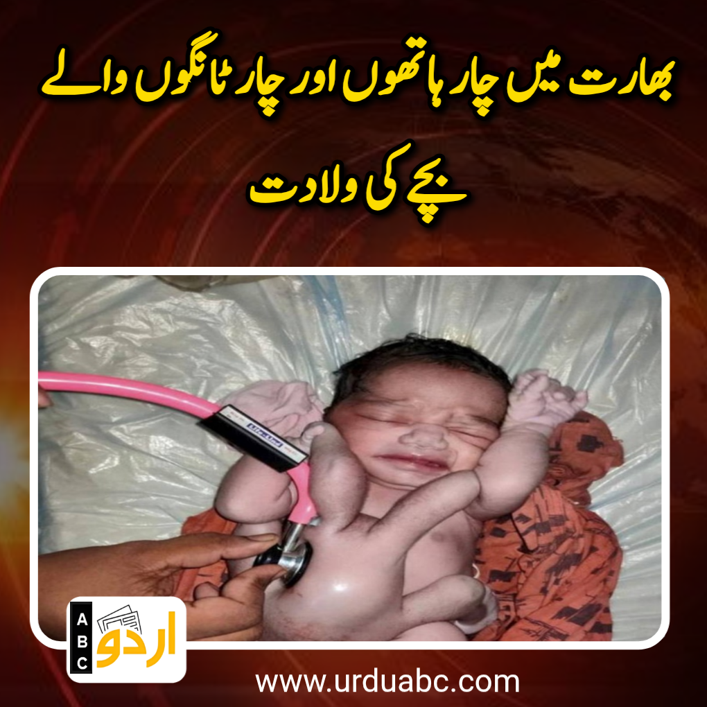 Child born with 4 hands and 4 legs